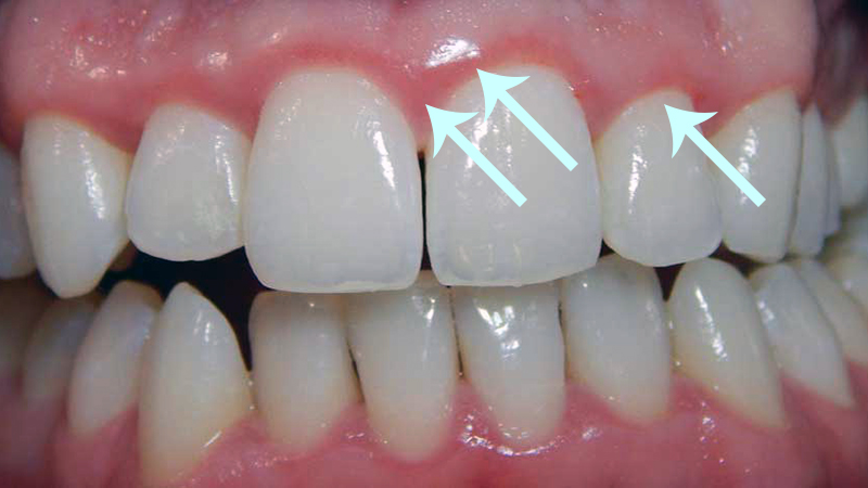 Equinácea: Fortalecendo suas Defesas Bucais - inspiração 1