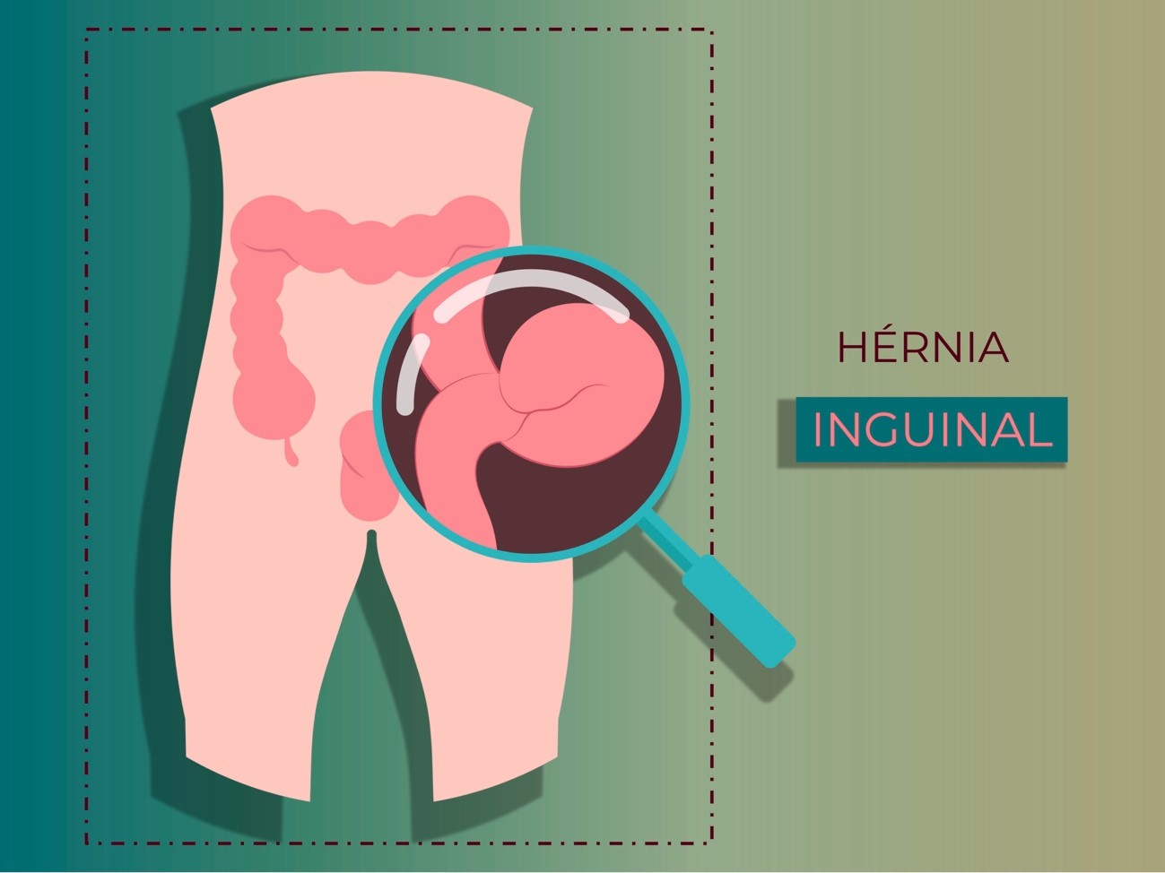 O que é hérnia inguinal e por que ela surge? - inspiração 1