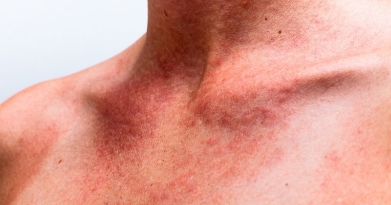 Urtiga: O Poder Natural Contra as Reações Alérgicas - inspiração 1