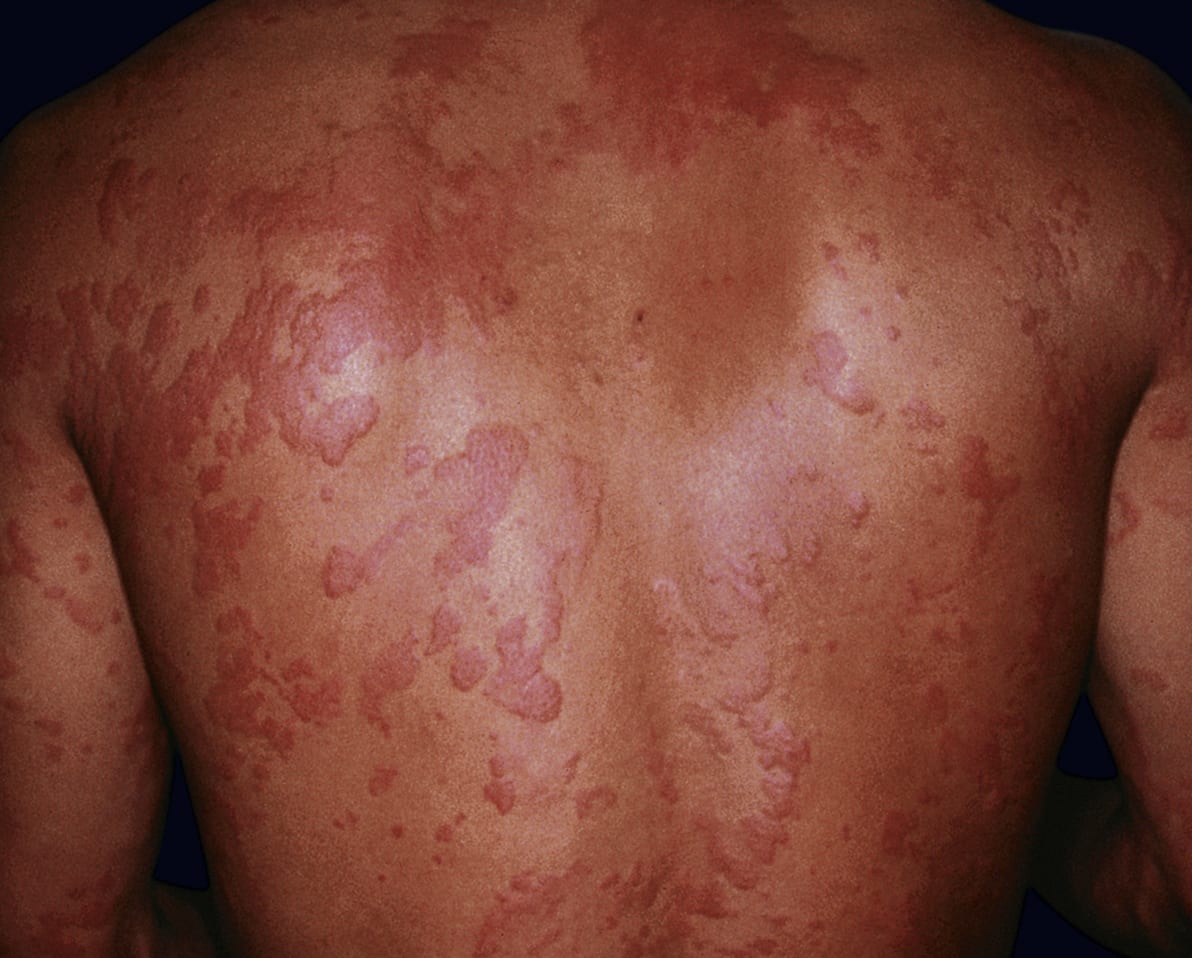 Os 5 principais alimentos que combatem alergias na primavera