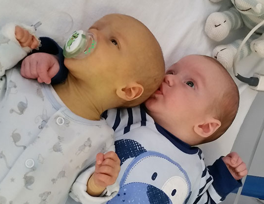 Mitos e verdades sobre remédios caseiros para icterícia infantil