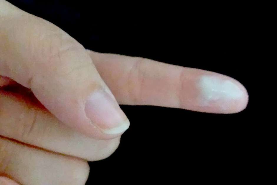 Entenda a candidíase e seus tratamentos naturais